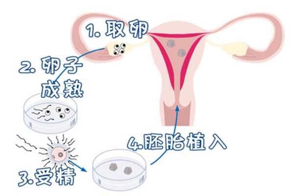贵阳中国供卵助孕_贵阳正规供卵机构_试管婴儿步骤流程详细介绍